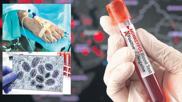 Türkiye’de ‘mpox’ iddiası