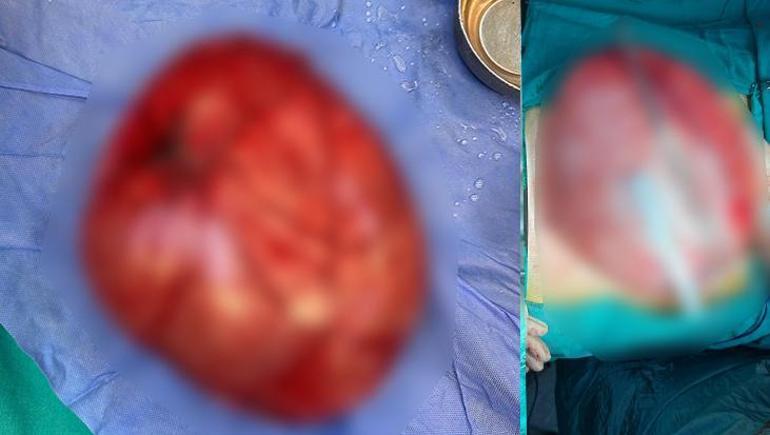 Kilo vermek için hastaneye gitti! 14 yaşındaki çocuğun karnından çıkan şaşkına çevirdi